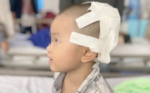 Bé trai 2 tuổi bị lõm hộp sọ do ngã xe đạp